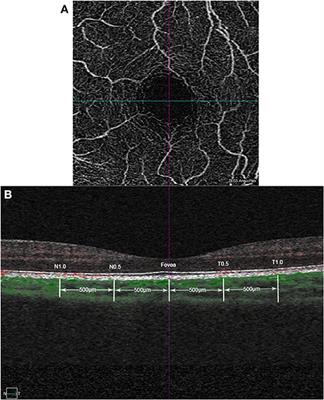 Compensatory Changes in the Anterior Segment and Vascular System of the Eye in Myopic Children After Orthokeratology
